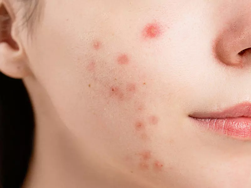 什麼是暗瘡？暗瘡是一種常見的皮膚疾病。